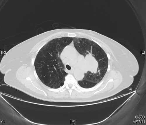 Small cell carcinoma - CT scan | Dr. Yale Rosen Atlas of Pulmonary ...