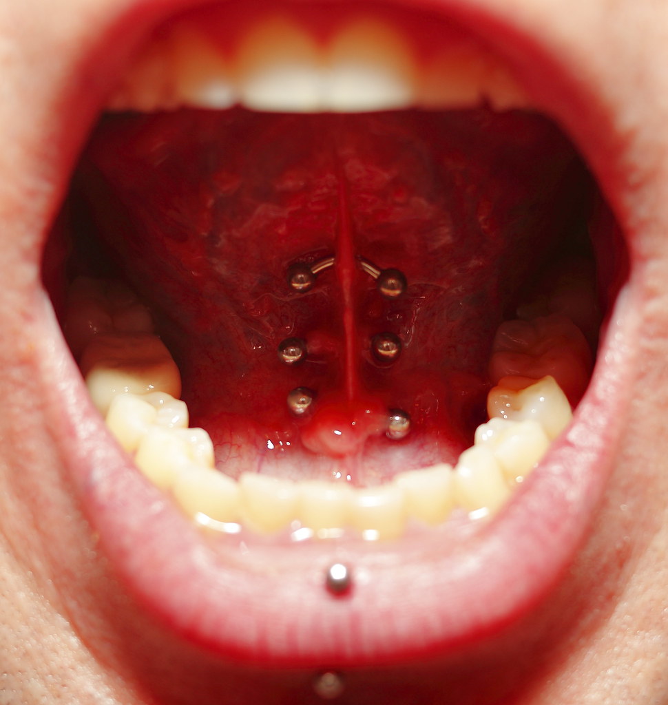 Triple Tongue Frenulum.