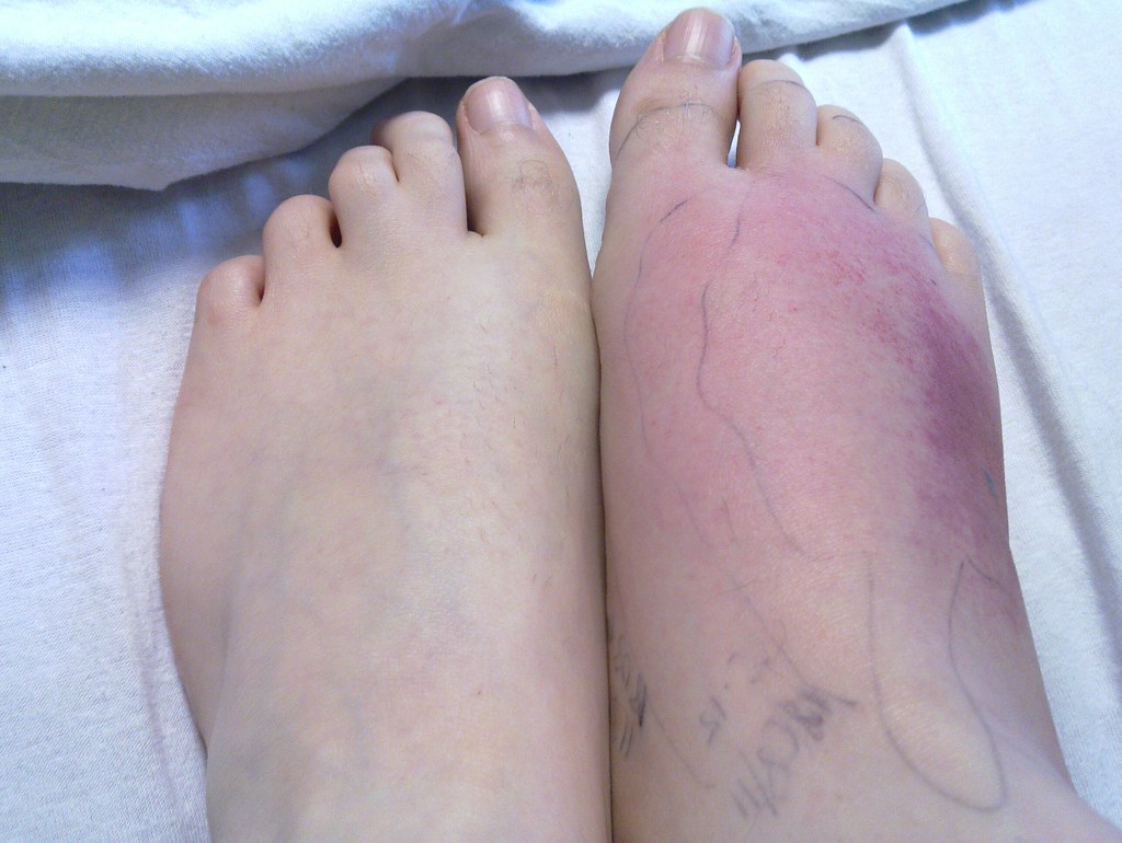 Manky feet pictures
