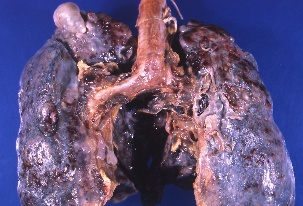 Sarcoidosis - Bullous emphysema
