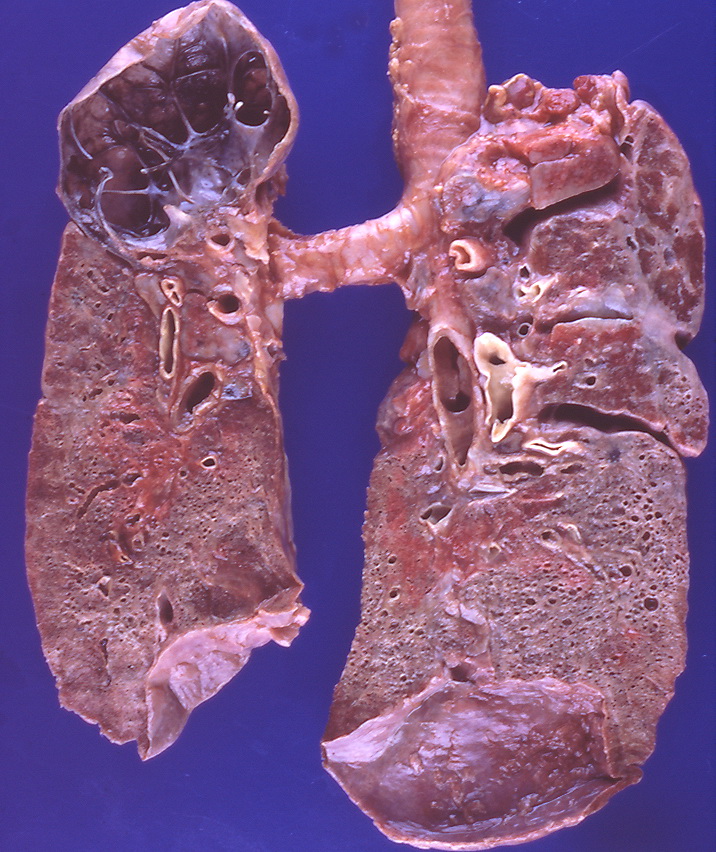 Sarcoidosis - Bullous emphysema, fibrosis, honeycombing