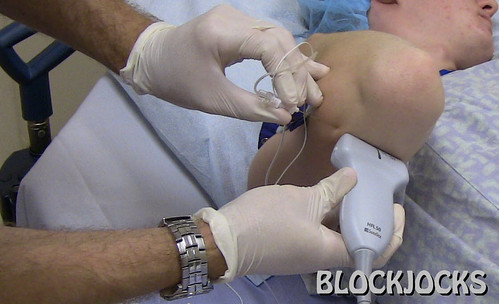 Ulnar Nerve Just Proximal to Elbow (Close Up) | by BLOCKJOCKS