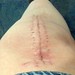 Staples out and nearly healed