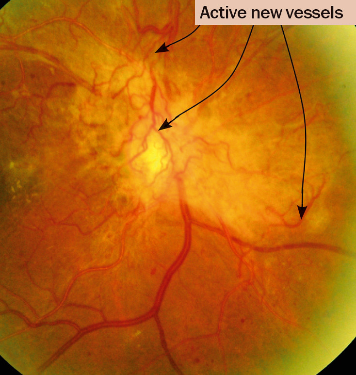 Eye before treatment for diabetic retinopathy
