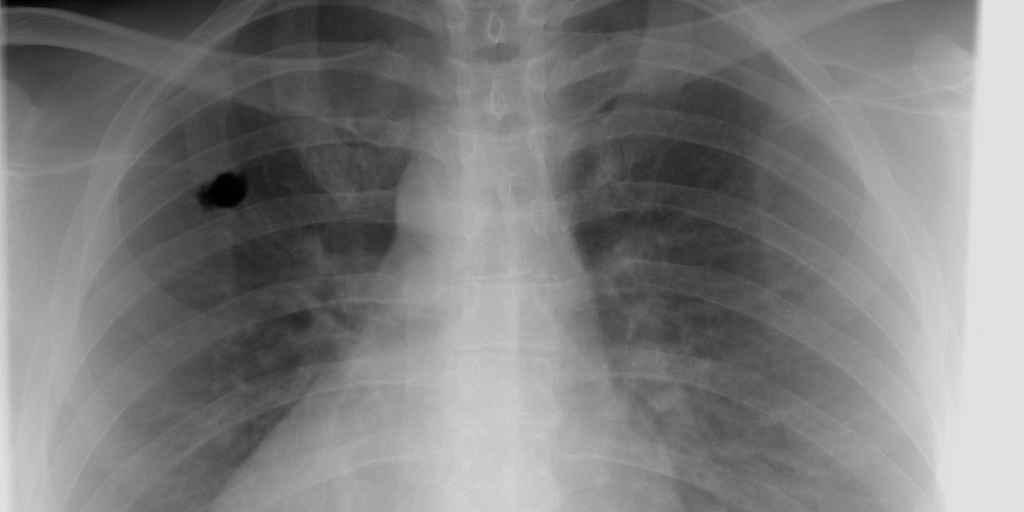 IA-google-cancer-poumons