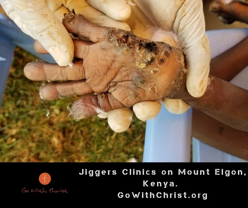 Jiggers Clinics on Mount Elgon