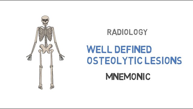 Well defined osteolytic lesions - easy way to remember - Mnemonic