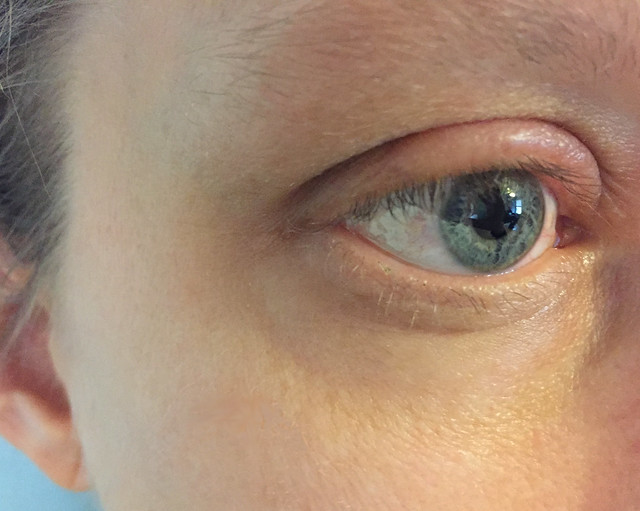 Swollen Eyelid Due to Allergy