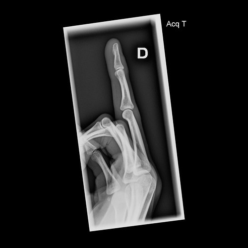 xray ray x fuck you gfy yourself go middle finger break fracture bone hospital accident black white hand flesh transparent experimental depression meme