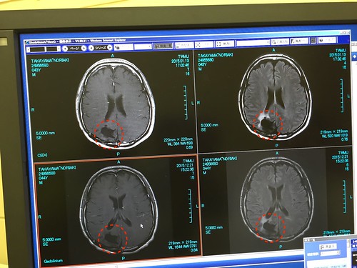 脳腫瘍摘出手術後の脳のMRI画像