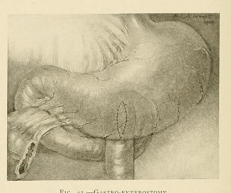 This image is taken from Page 150 of Duodenal ulcer