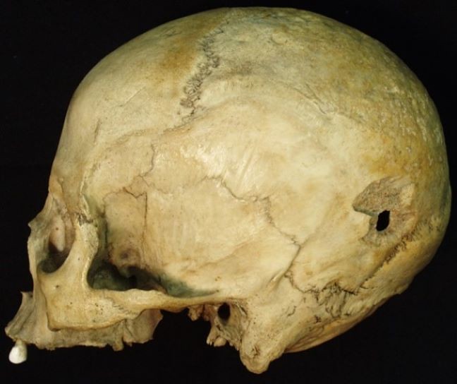 A skull showing an exit wound caused by high-velocity projectile trauma