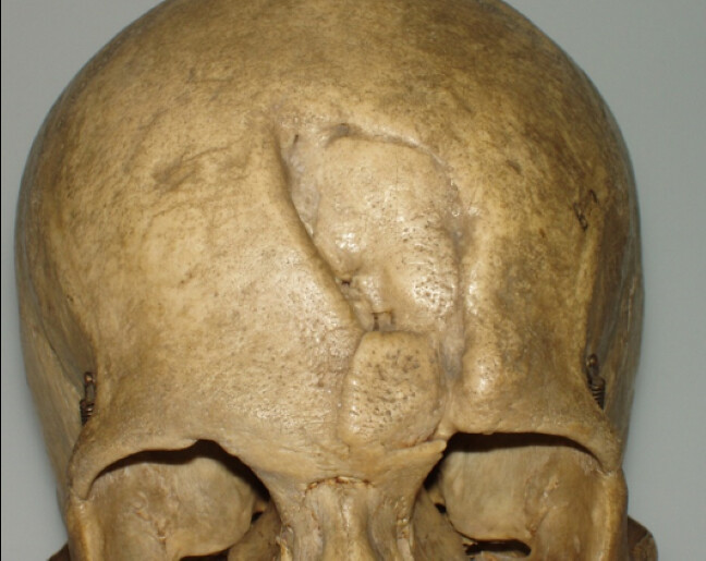 Skull with a well-healed injury to the forehead. The skull looks like it had been partially caved in it but the fracture edges have united and are rounded