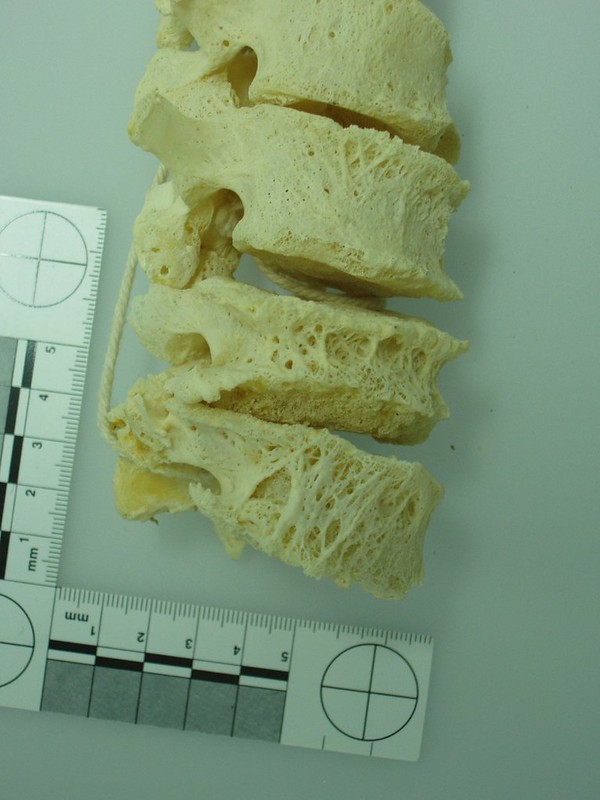 Vertebrae with osteoporosis. Some of the vertebral bodies are compressed and show a loss of bone mass