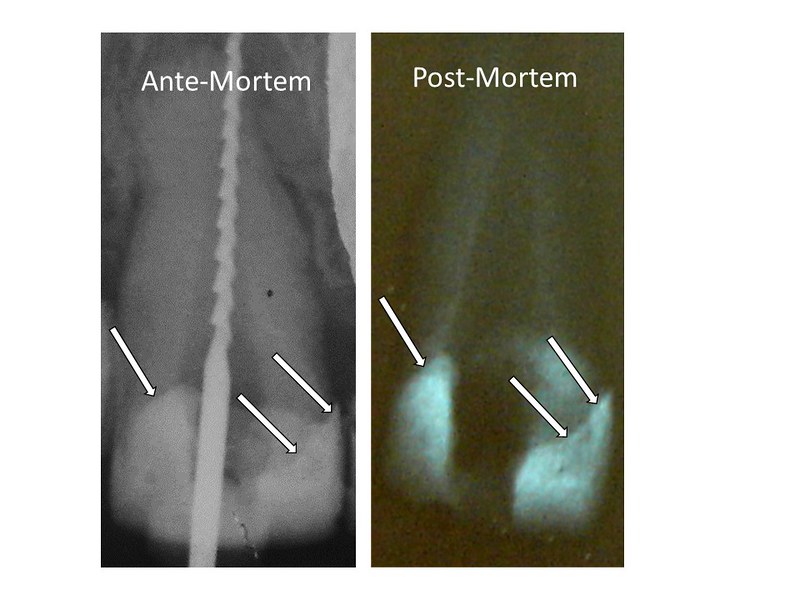 Two radiographs: The one on the left is an ante-mortem radiograph of a tooth and the one on the right was taken post-mortem. Arrows on both radiographs highlight similar features of dental fillings between the two