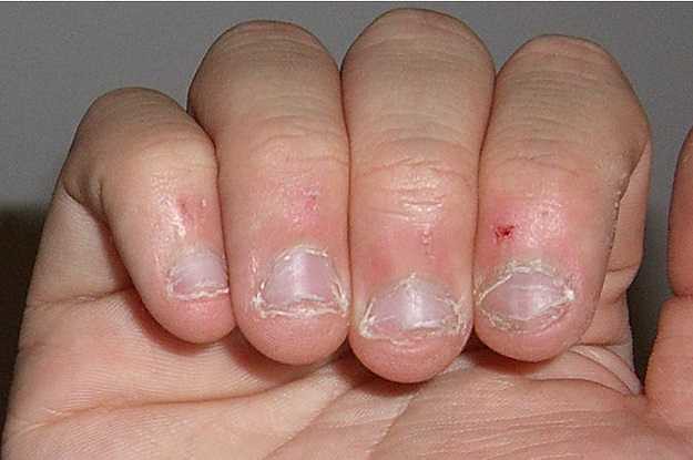3418 Why you should not bite the skin around your nails