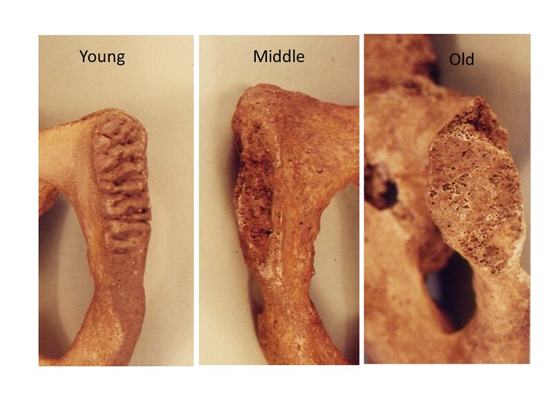 A series of pubic symphyses demonstrating age-related changes, from young to old