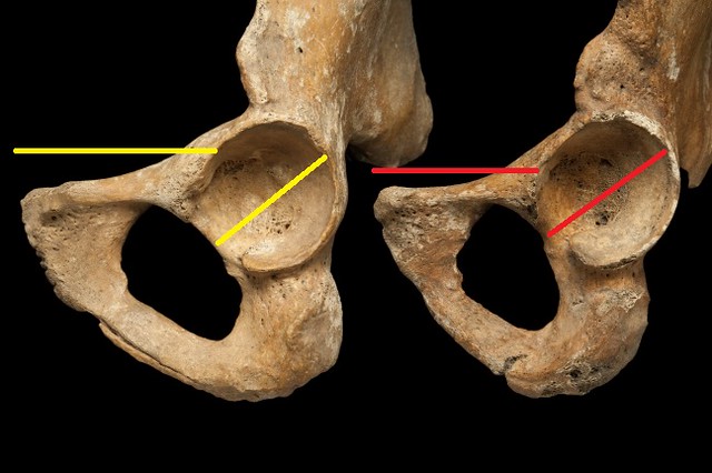 Male and female pelves from a side view displaying the iliopubic ramus and acetabulum