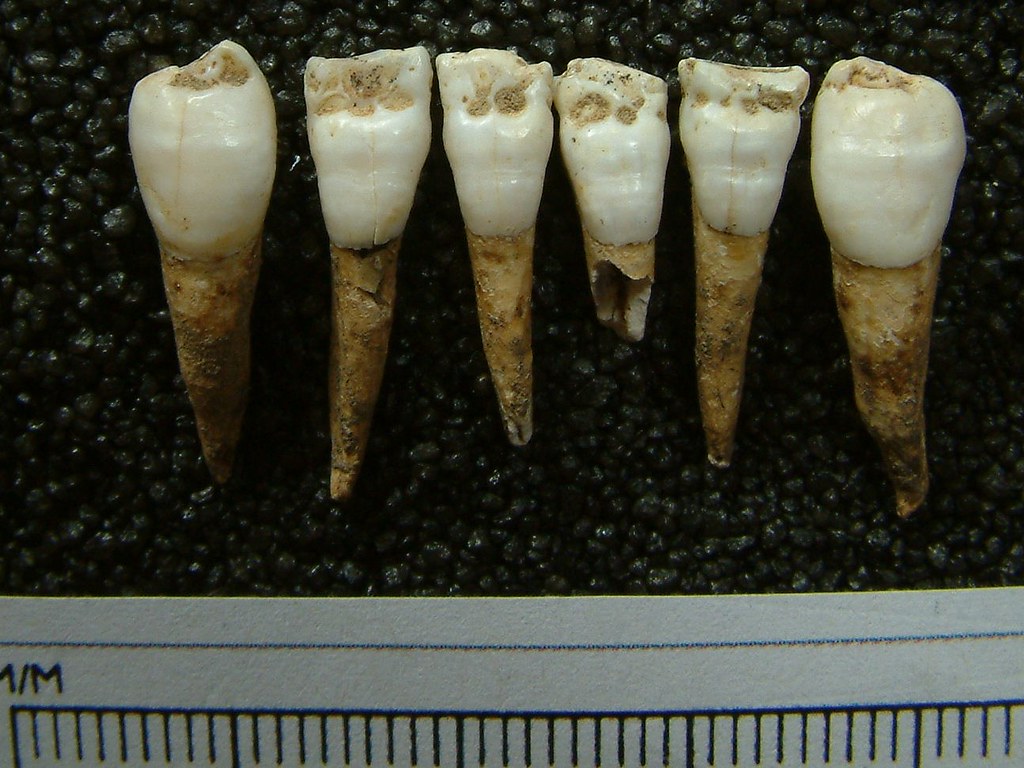 The lower front teeth from an individual. All of the teeth show lines and/or pits in the enamel surface