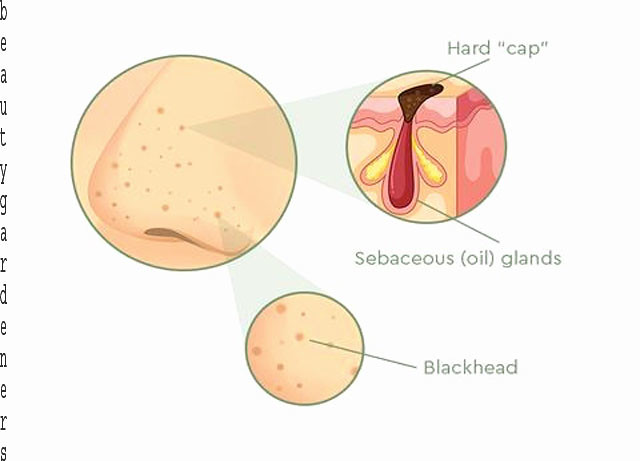 what-are-blackheads