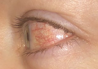 Zombie eyeball disease 2.0