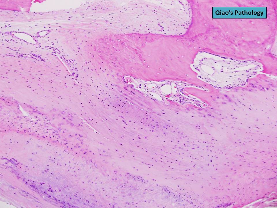 Qiao's Pathology: Ossification of the Achilles Tendon
