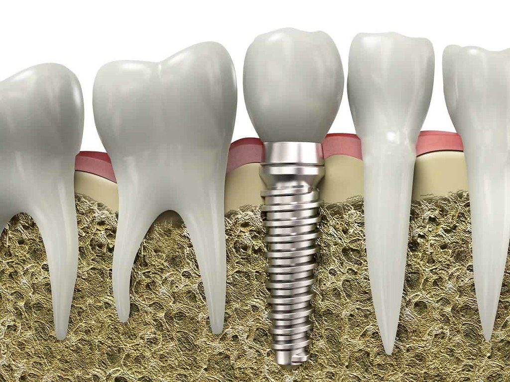 Why You Should Look into Dental Implants | Considering denta… | Flickr