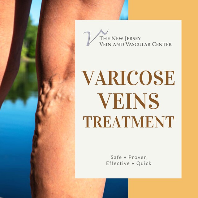 Varicose Veins Treatment NJ