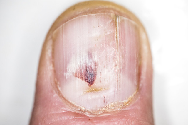 Nail of a working man split and with hematoma