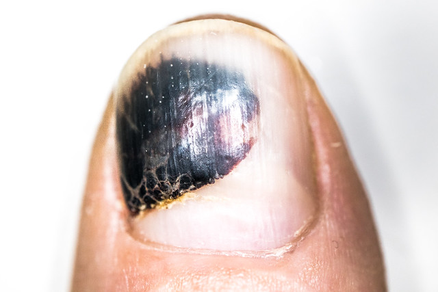 Bruising under the nail close-up