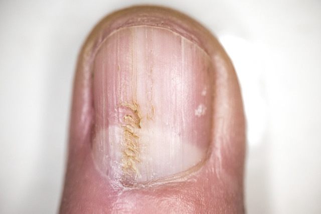 Nail fungal infection close-up