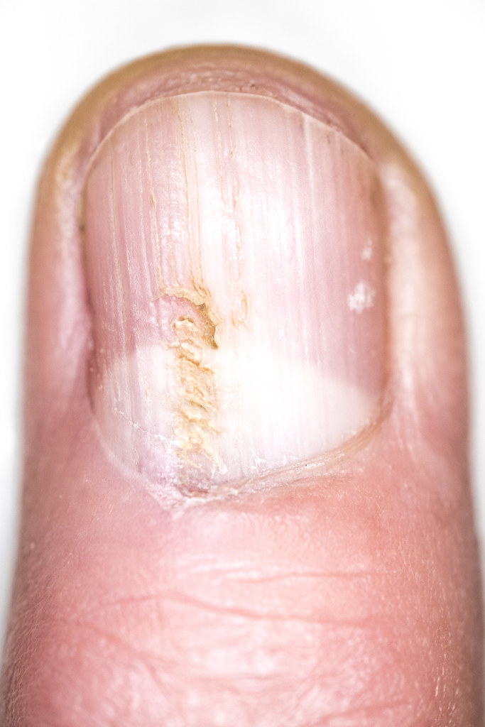 How To Cure Nail Fungus