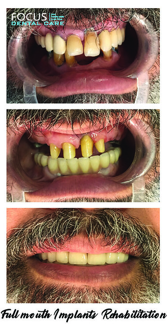 Full Mouth Implants in Hyderabad