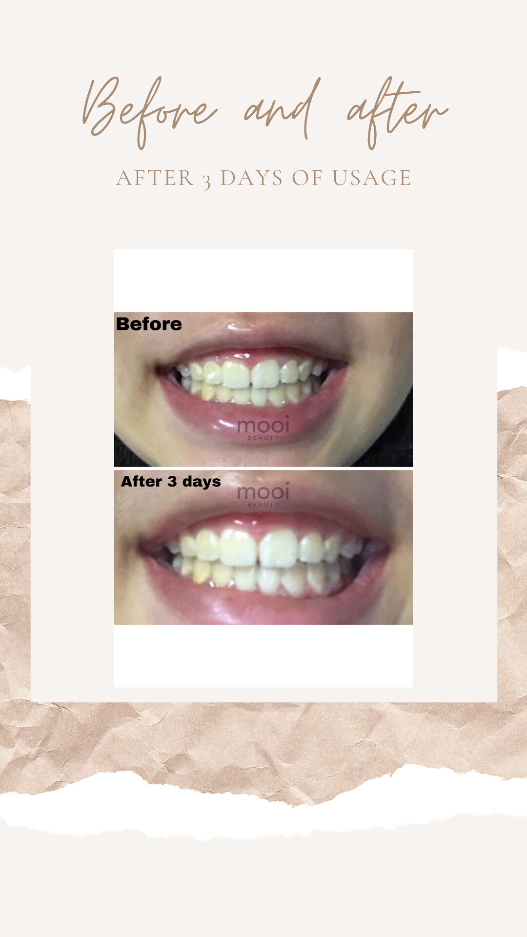 mooi teeth whitening before after
