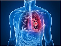 Mesothelioma Meme Meanings & Definitions