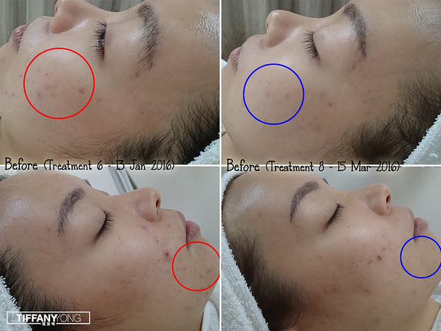 Skin Science Forlled 3 months treatment