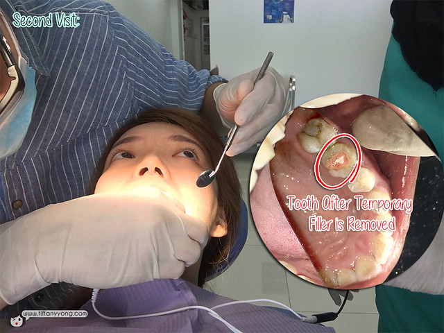 icare-dental-after-root-canal-visit-2