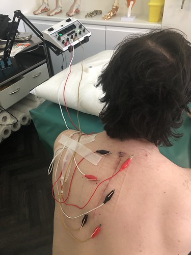 Multiple fractures thoracic vertebrae | by Dr Les Bailey - Patient Testimonials