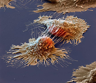 Cancer cells | by samlevin