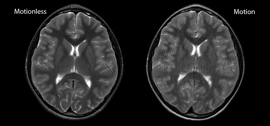 MRI Brain Scann_Motion-Non Motion