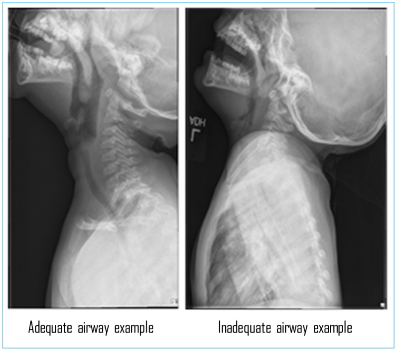 Examples of adequate and inadequate lateral airway radiographs