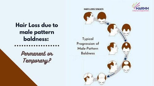 Hair Loss due to male pattern baldness: Permanent or Temporary?