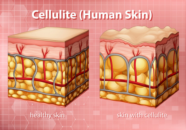 5 Tips to Finally Get Rid of Cellulite