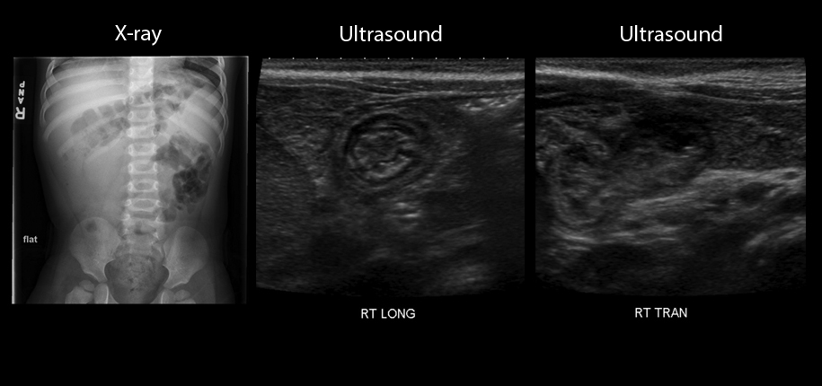 abdomen plain film and ultrasound image