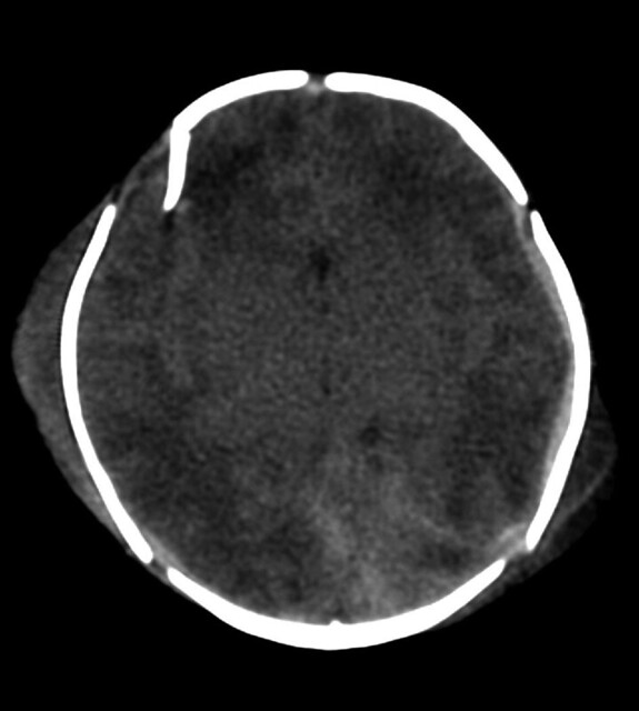 SKULL FRACTURE WITH BRAIN LACERATION AND SUBSEQUENT CYSTIC ENCEPHALOMALACIA