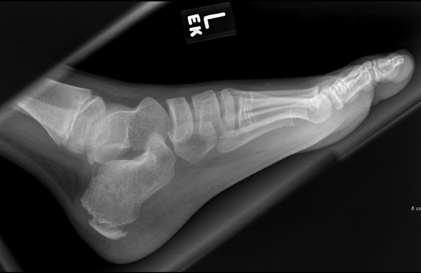 coarse trabeculations of the calcaneus