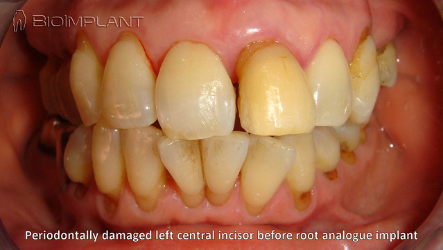 ***THE COMPLETE CASE RELATED TO OUR LAST QUIZ***  The left central incisor, with status post apicoectomy and with periodontal lesion, was replaced with a two-piece, root-analog, ceramic, immediate implant with root extension.  www.bioimplant.at