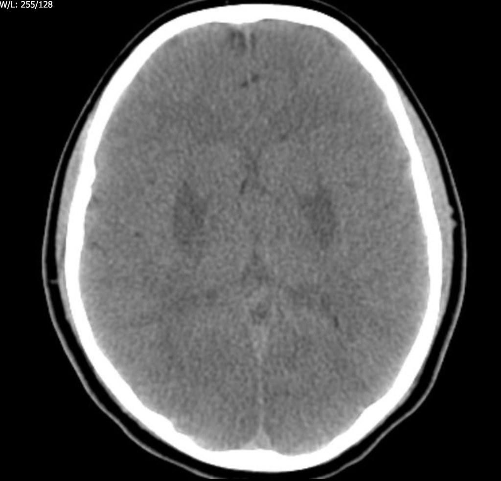 Splenium Ct drowning example-ct | Hypodense corpus callosum and splenium… | Glenn ...