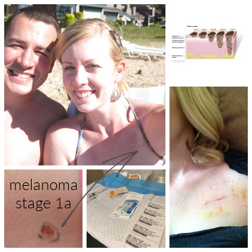 my melanoma
