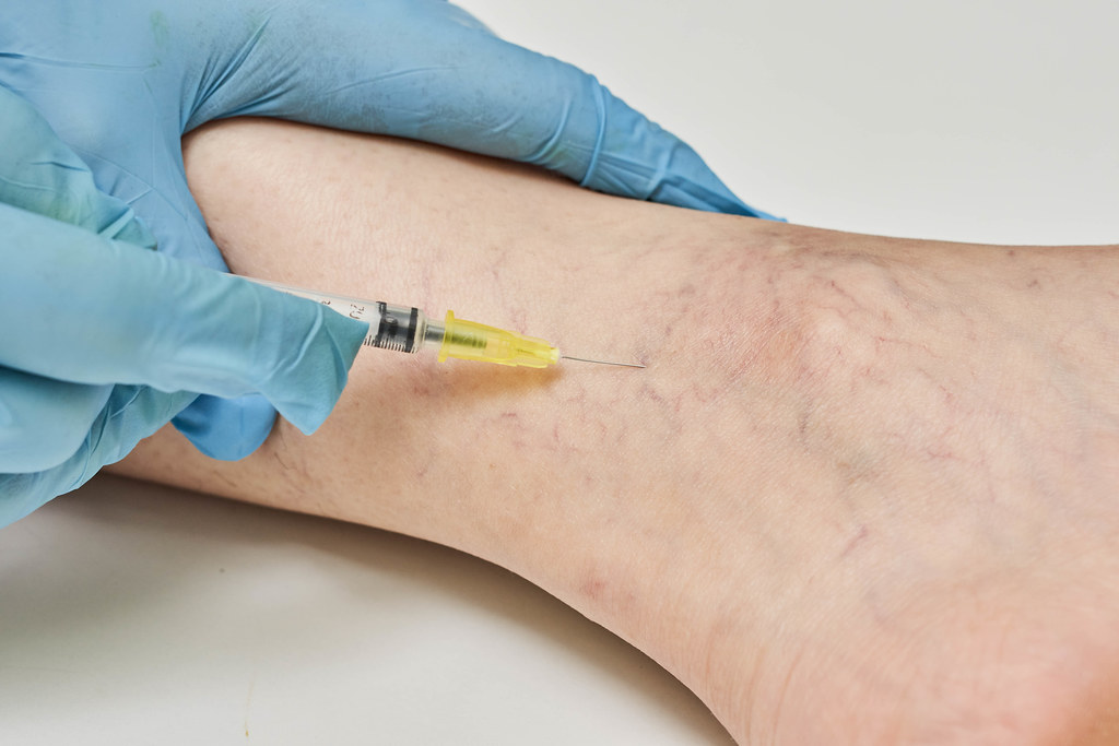 Sclerotherapy for varicose and spider vein treatment